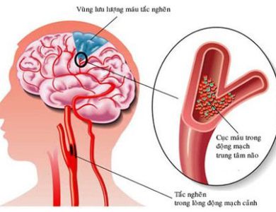 ĐỘT QUỴ NÃO LÀ GÌ? DẤU HIỆU, NGUYÊN NHÂN VÀ PHÒNG NGỪA