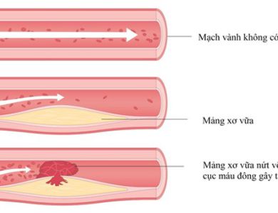 CỤC MÁU ĐÔNG LÀ GÌ?